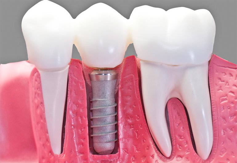 Dental Implant