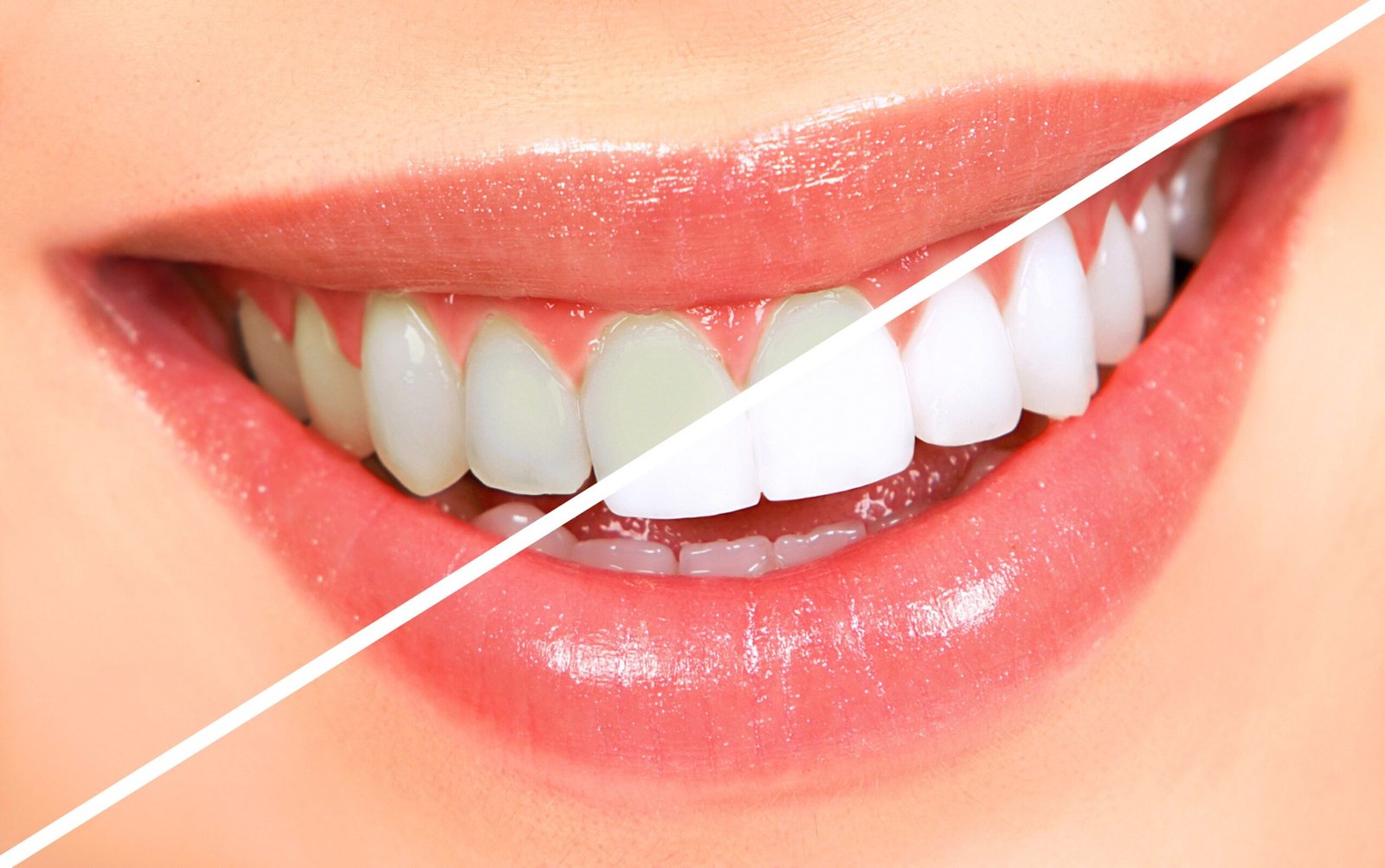 Dental bleaching