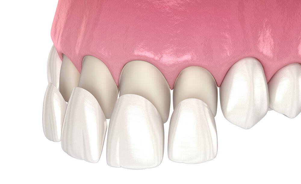 Dental Veneers